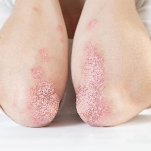 person's elbows with a rash