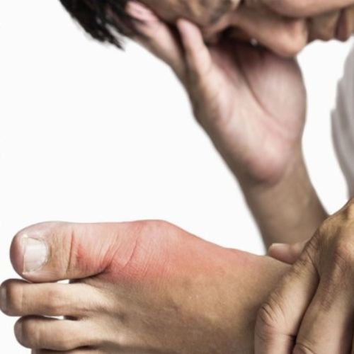image of a man holding his feet which has been affected by gout