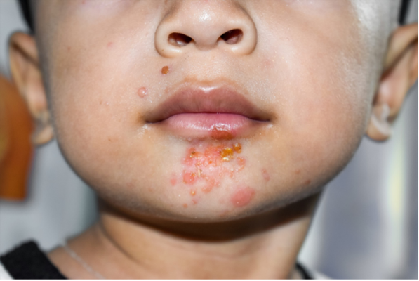 zoom to lower face of a small child that presents large amount of red pimples